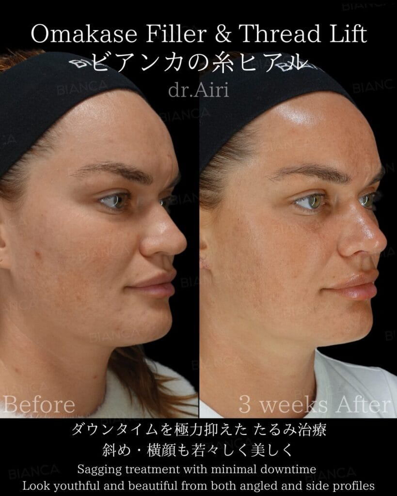 Private: Tokyo Tear Trough Filler Guide: Gentle, Evidence-Based Aesthetic Surgery Advice