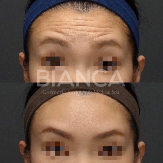 Botox Clinic Near Me in Tokyo: A Calm, Expert Guide to Safe, Natural Results