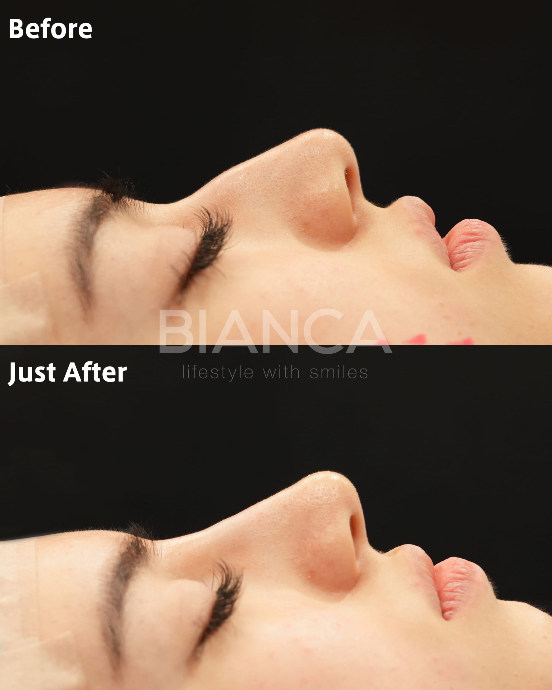 Smooth Confidence: A Beginner’s Guide to Dermal Filler Injections