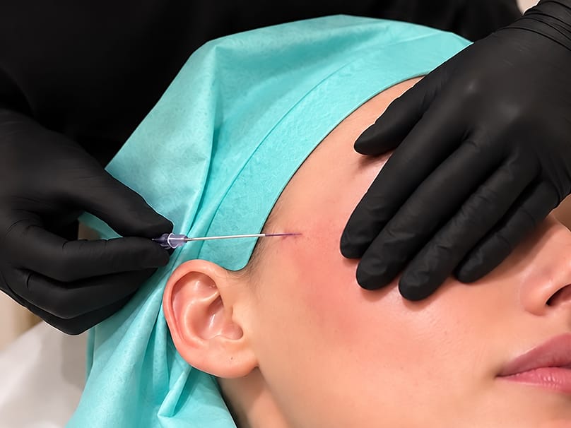 Gloved hands performing a thread lift near the hairline before Morpheus8 Burst treatment
