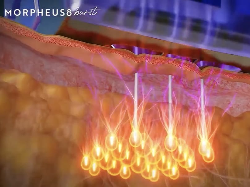 Morpheus8 Burst microneedles delivering RF thermal energy at multiple skin depths