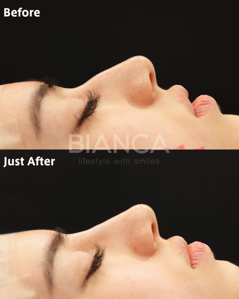 Rhinoplasty in Japan: Precision Aesthetics for International Patients in Tokyo
