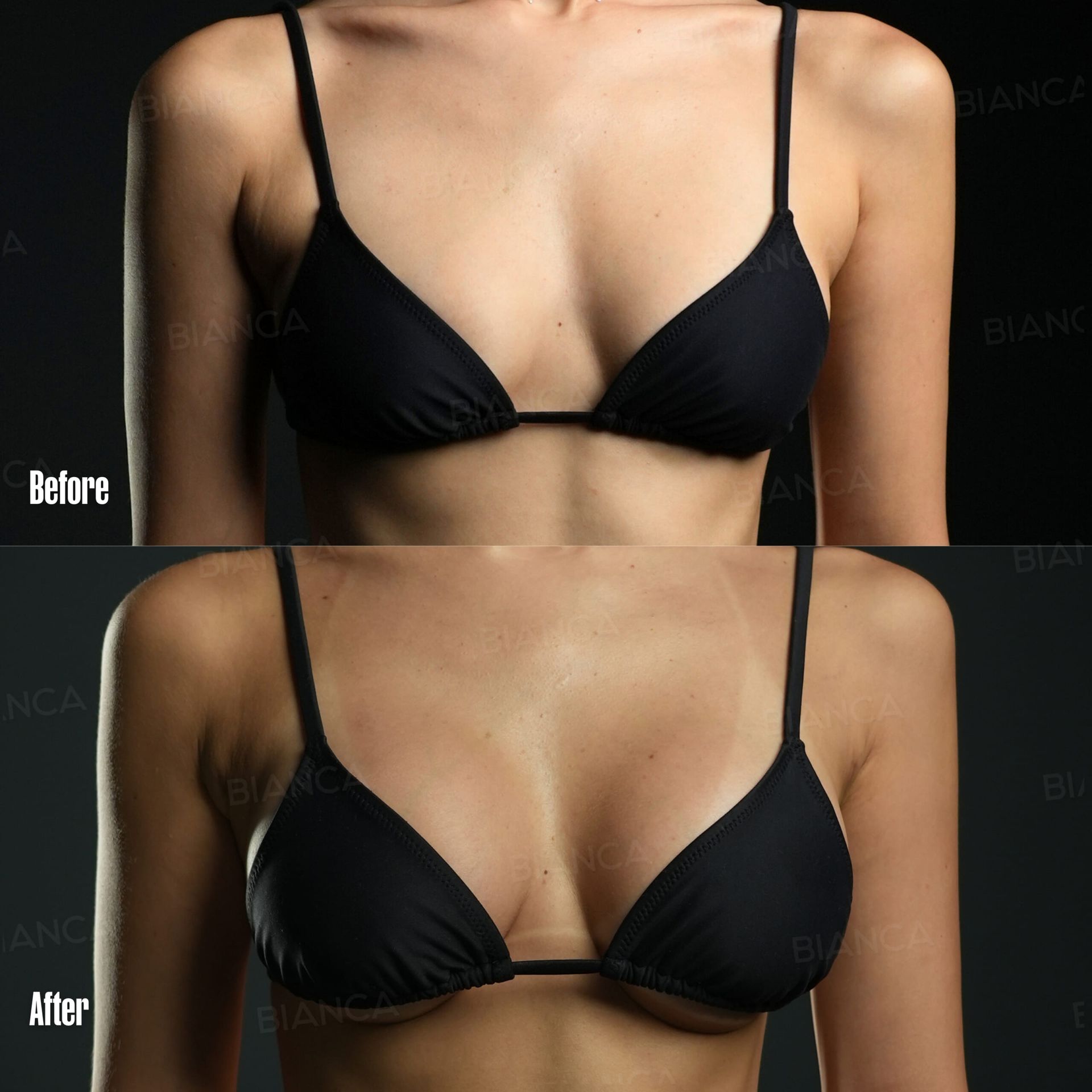 What is the best Breast Augmentation option for you? Explaining Silicone Implants, Fat Grafting, and Hybrid Techniques