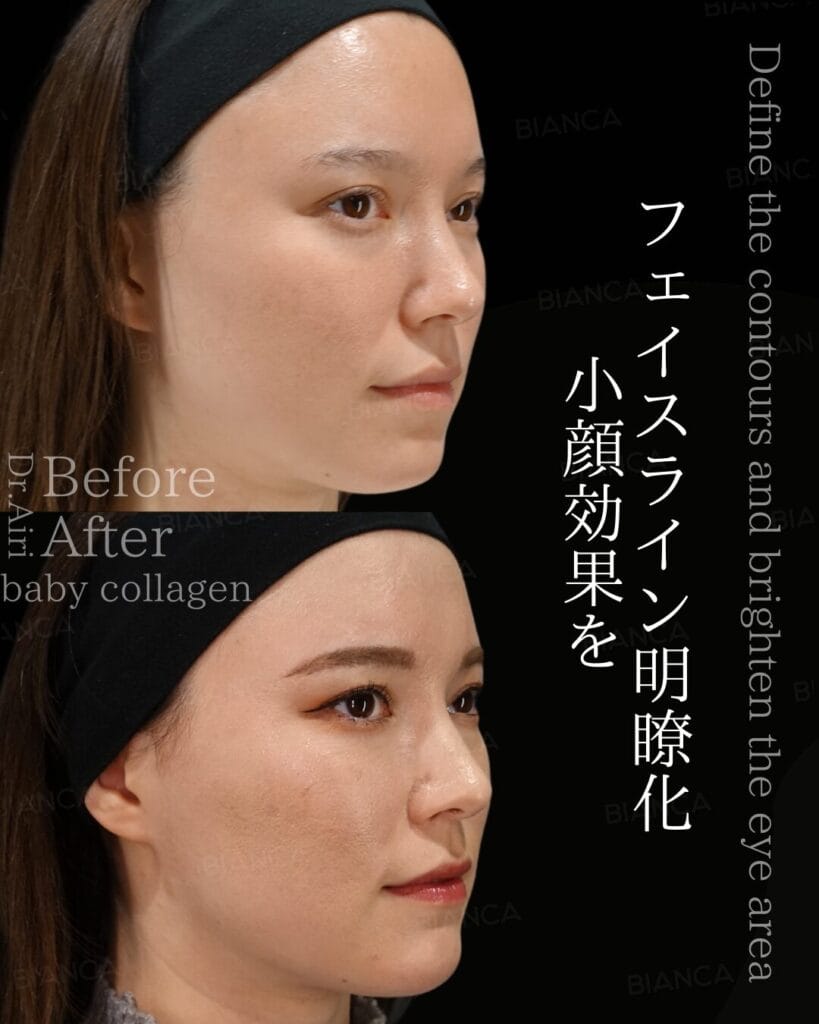 Masseter Botox in Tokyo: The Best Way for a Refined Jawline