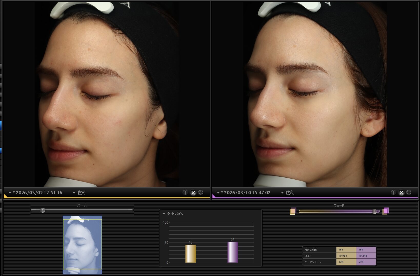 HydraFacial Tokyo: The Remarkable Medical Spa Treatment with Fantastic Results