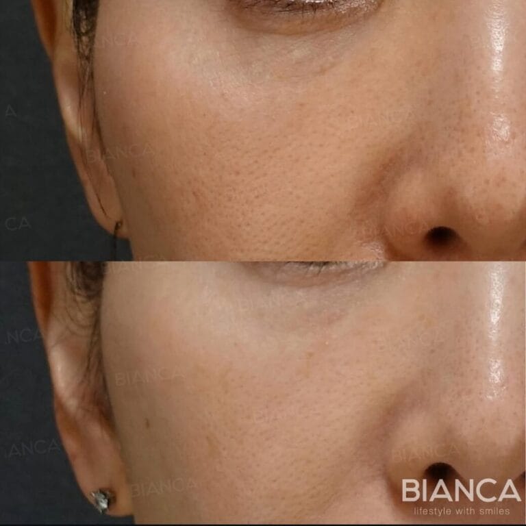 Glass Skin Peels by BIANCA CLINIC in Tokyo