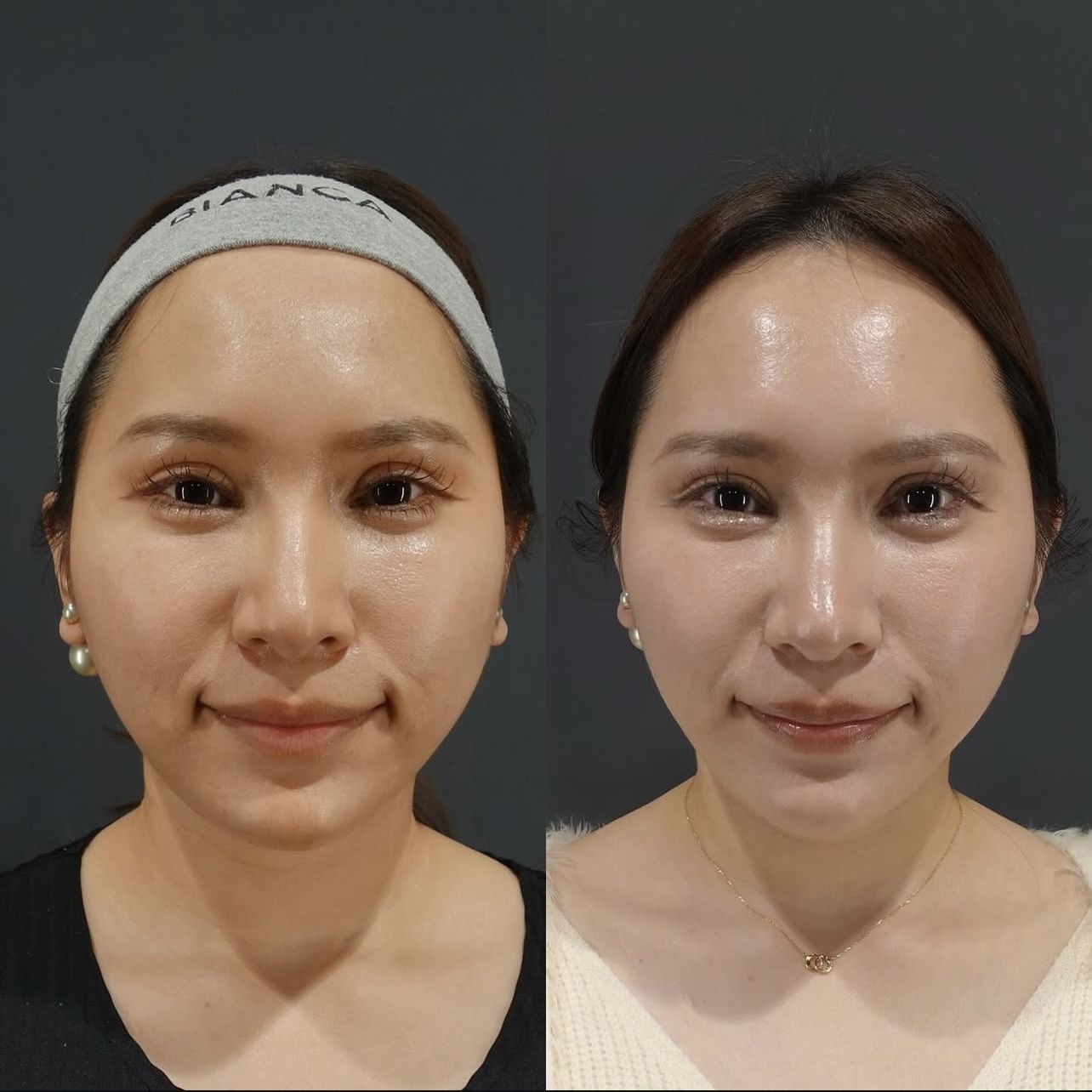V Lift: The Gentle Non-Invasive Jawline Contouring Procedure at BIANCA CLINIC in Tokyo