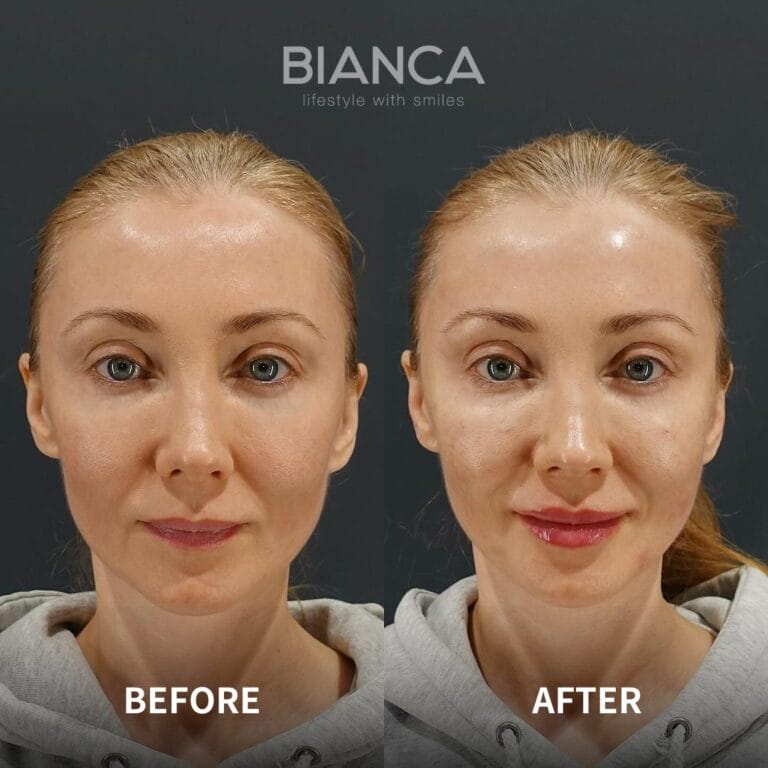 Rejuran Before and After: What to Expect at a Tokyo Medical Spa