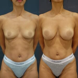 Before and after: Hybrid breast augmentation (silicon implant + CRF).