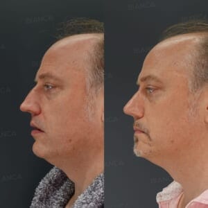 Before and after photos of nasal tip reduction surgery.