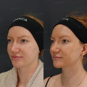 Morpheus8 【Submandibular】/ EmbraceRF【FACE】/ Lipo Suction 【Submandibular】