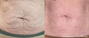 morpheus8 mommy makeover｜Trust BIANCA in Tokyo, Japan for morpheus8 mommy makeover and postpartum skin treatment. morpheus8 mommy makeover BIANCA in Tokyo, Japan