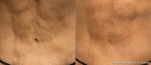 morpheus8 mommy makeover｜Trust BIANCA in Tokyo, Japan for morpheus8 mommy makeover and postpartum skin treatment. morpheus8 mommy makeover BIANCA in Tokyo, Japan