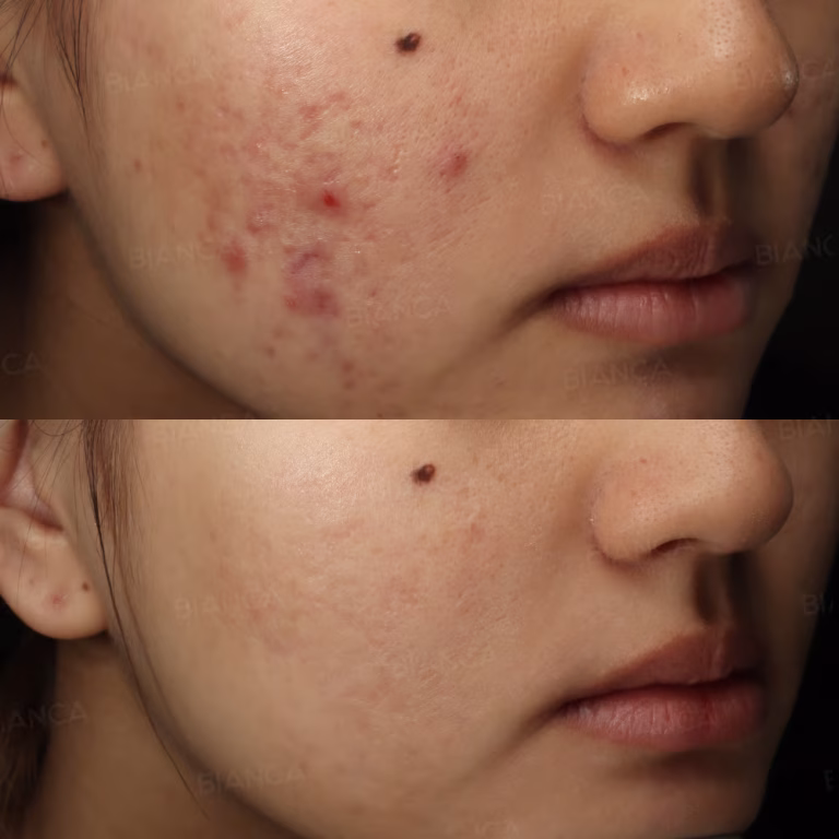 Japanese Treatment for Acne: English-Speaking Guidance at Tokyo’s Leading Medical Spa
