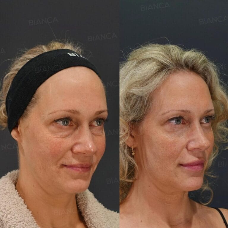 Surgery to Remove Puffy Eyes: Tokyo Lower Eyelid Blepharoplasty
