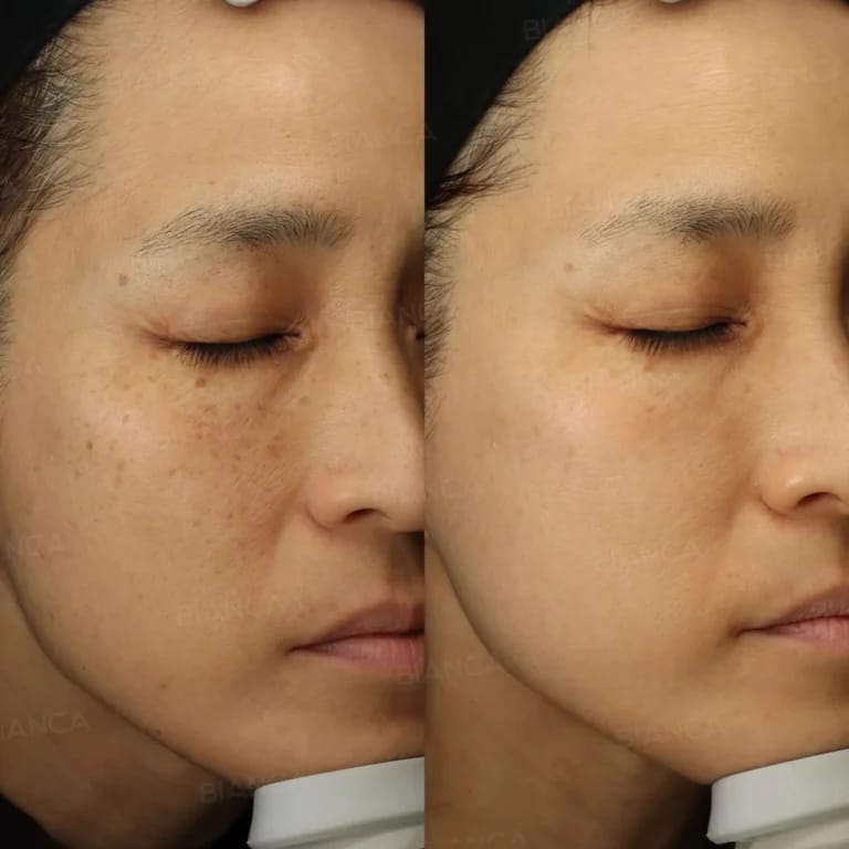 What Is Glass Skin? Unpacking Dewy Radiance at a Medical Spa in Tokyo