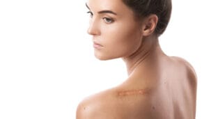 keloid removal|Trust BIANCA in Tokyo, Japan for keloid