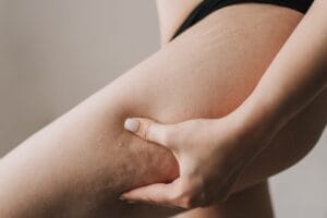 cellulite treatment｜Trust BIANCA in Tokyo, Japan for cellulite treatment, essential medical insights for your first steps. cellulite treatment BIANCA in Tokyo, Japan