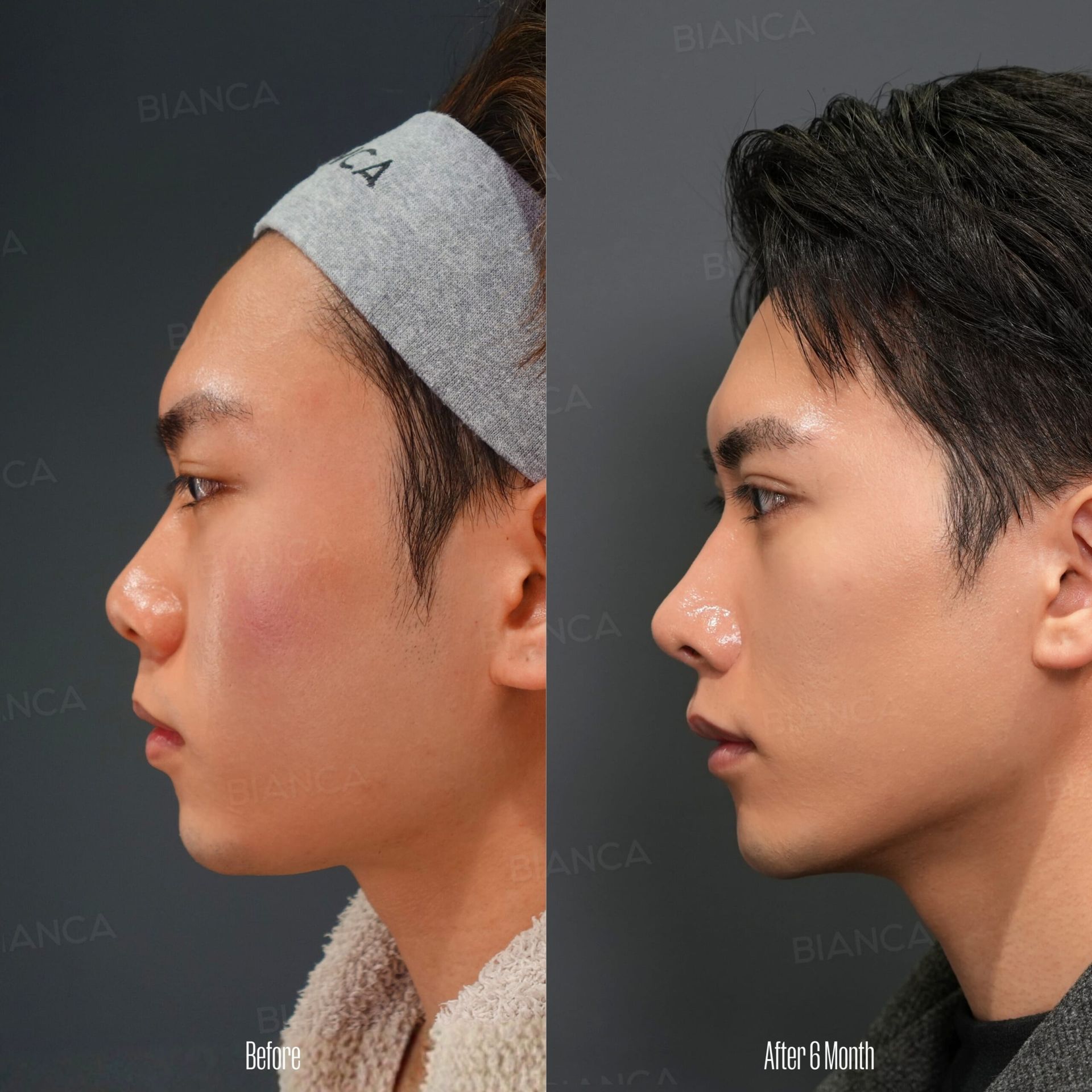 Japanese Nose Jobs: The Art of Natural & Precise Plastic Surgery in Tokyo