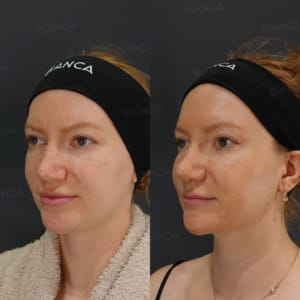 Morpheus8 【Submandibular】/ EmbraceRF【FACE】/ Lipo Suction 【Submandibular】