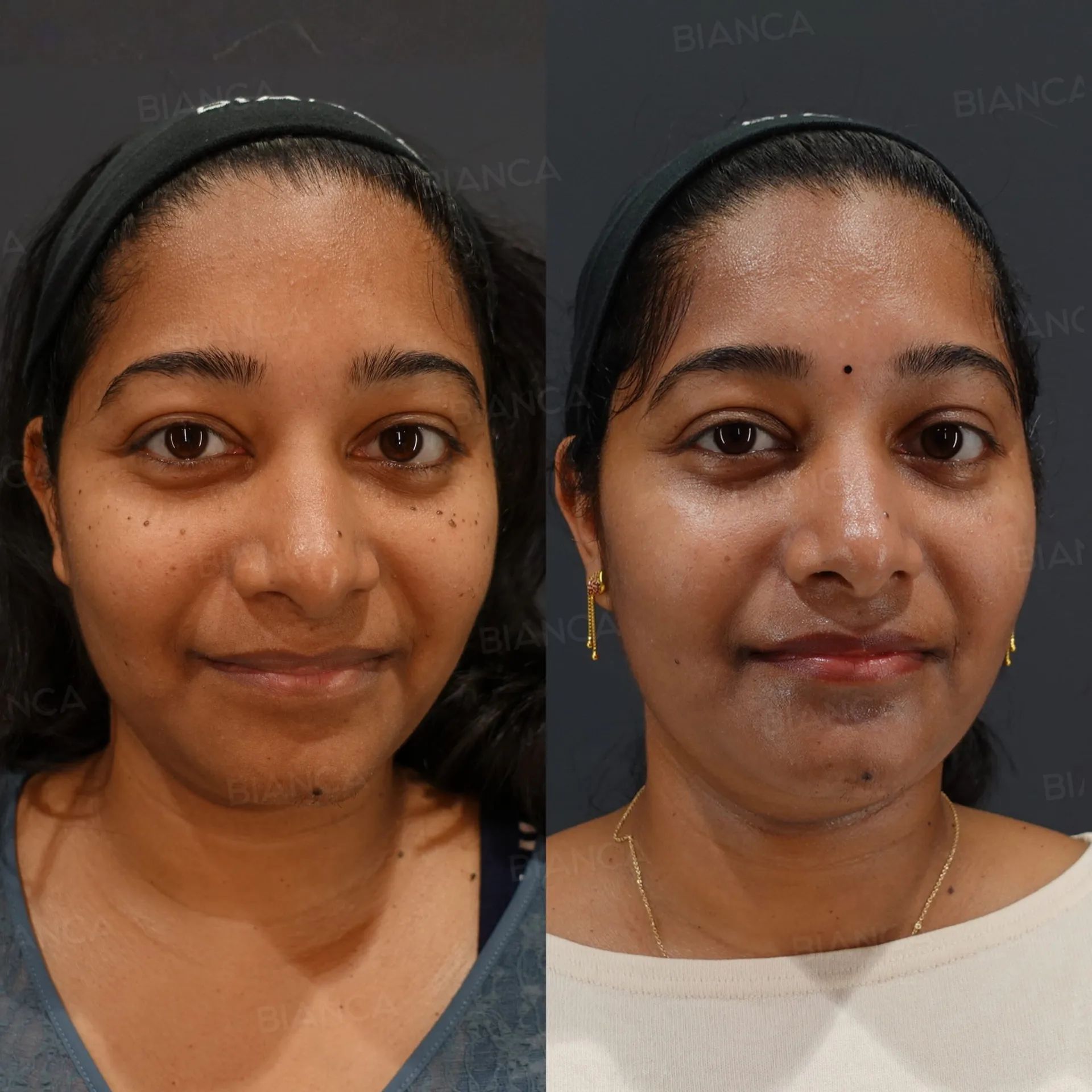 Facials: Tokyo Level Medical Spa Safety for Glowing Skin at BIANCA CLINIC