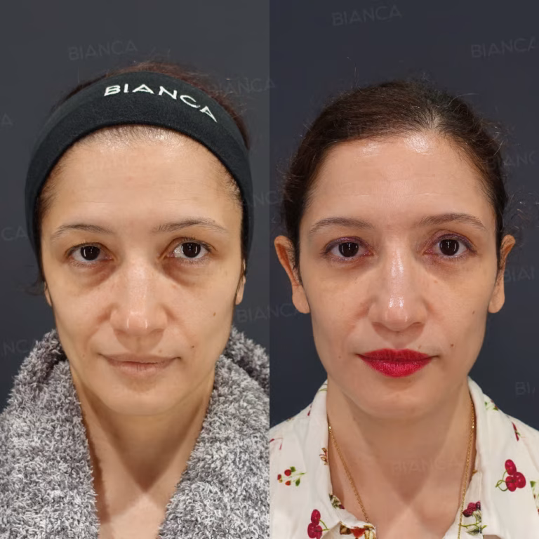 Surgery for Baggy Eyes at a Friendly English-Speaking Beauty Clinic in Tokyo