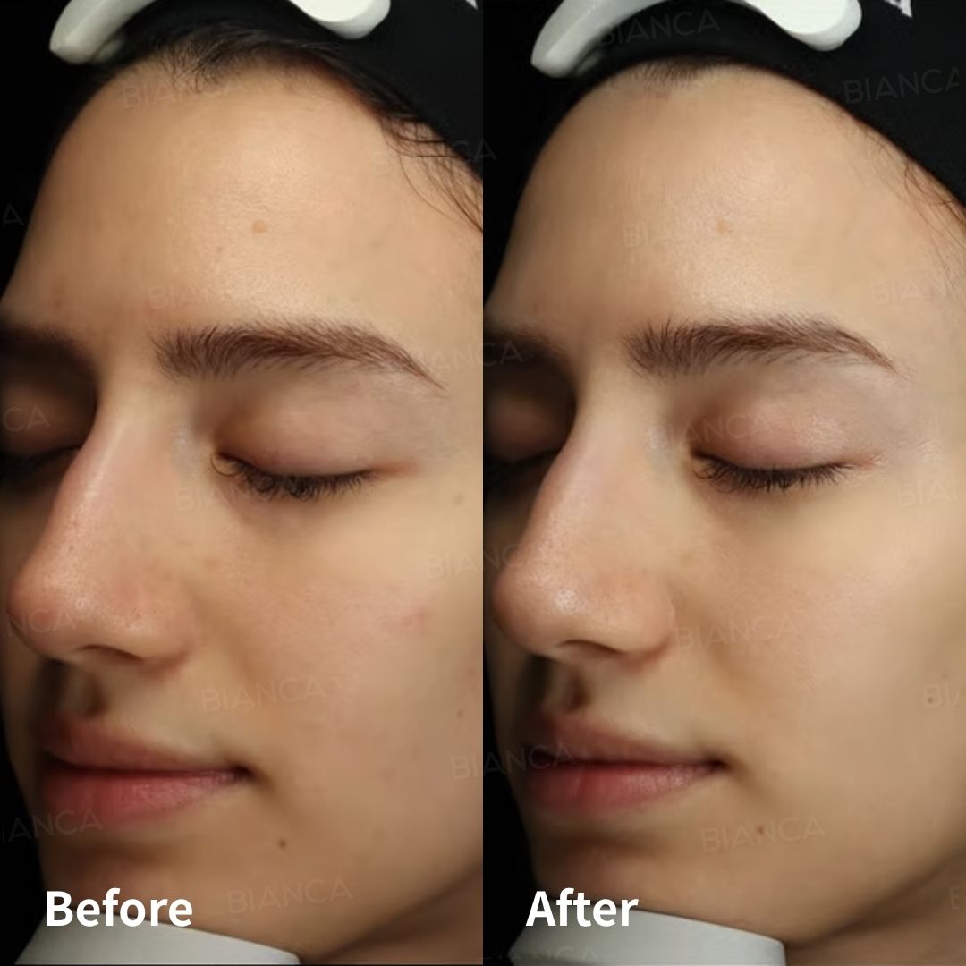 Protected: Hydrafacial® at BIANCA : A Smile as Radiant as Your Skin