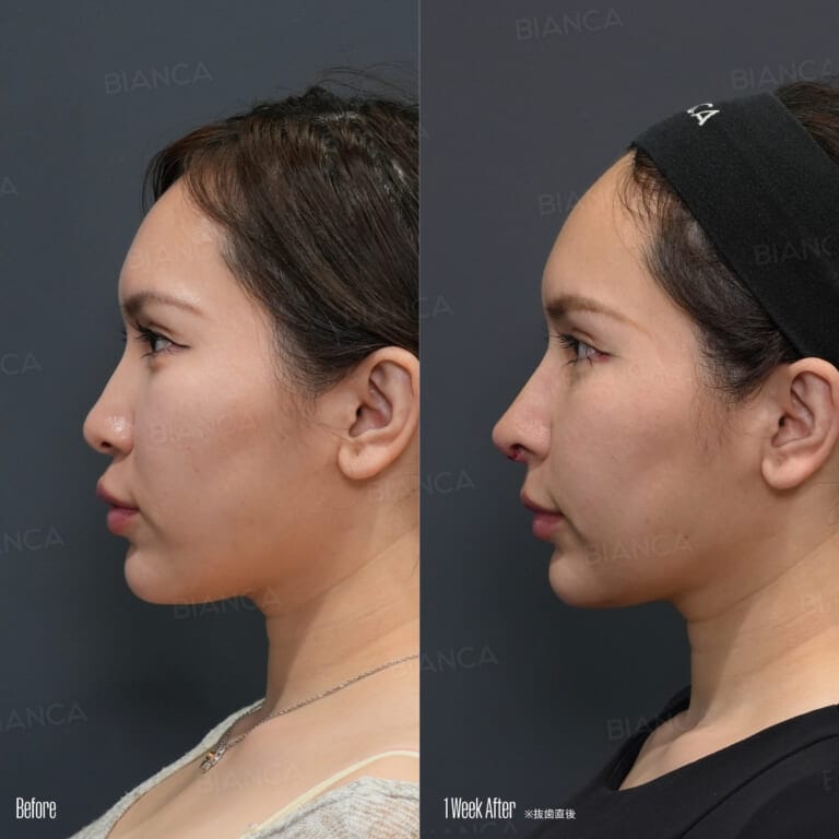 Japan Nose Job: Plastic Surgery for Natural, Balanced Results at BIANCA CLINIC in Tokyo