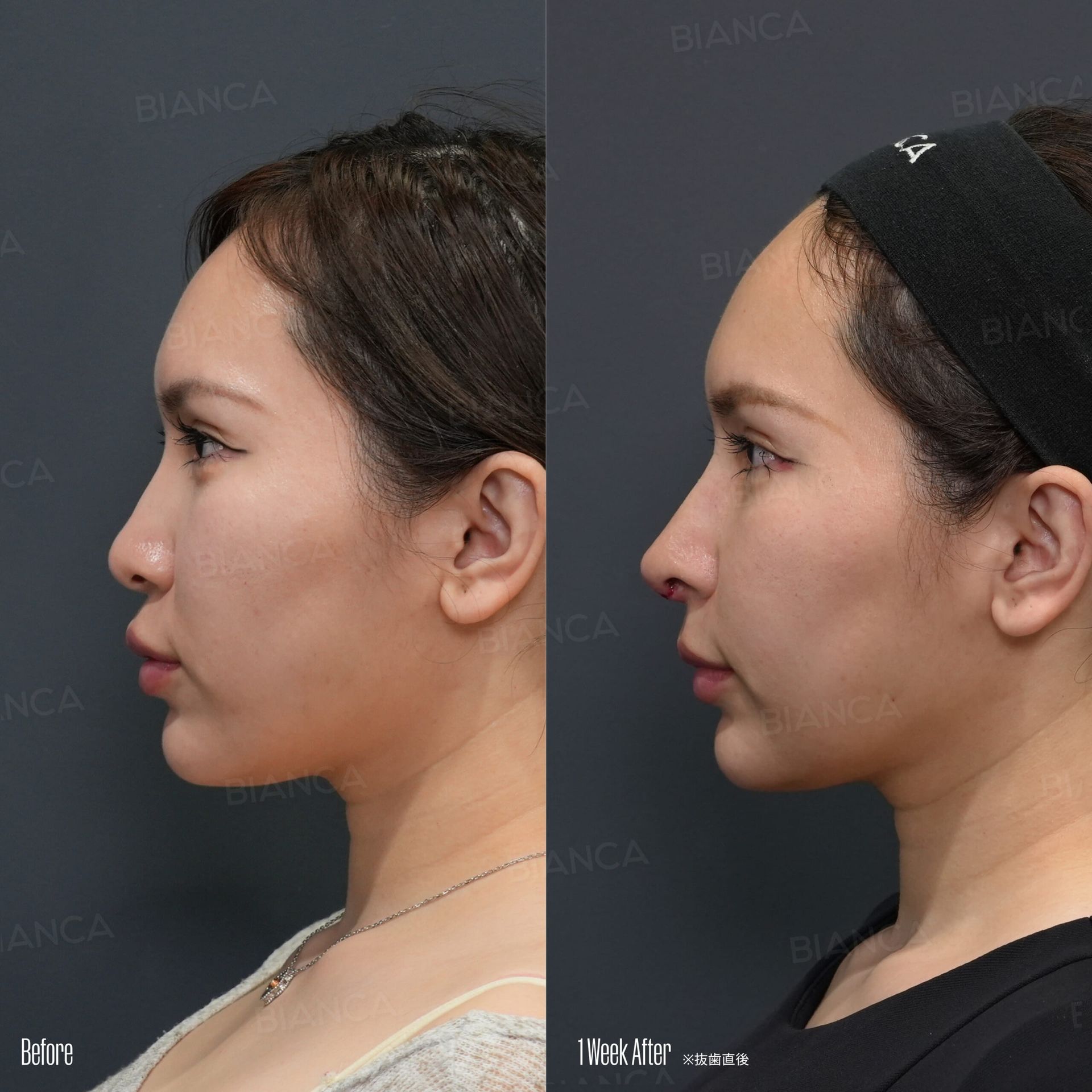 Japan Nose Job: Plastic Surgery for Natural, Balanced Results at BIANCA CLINIC in Tokyo