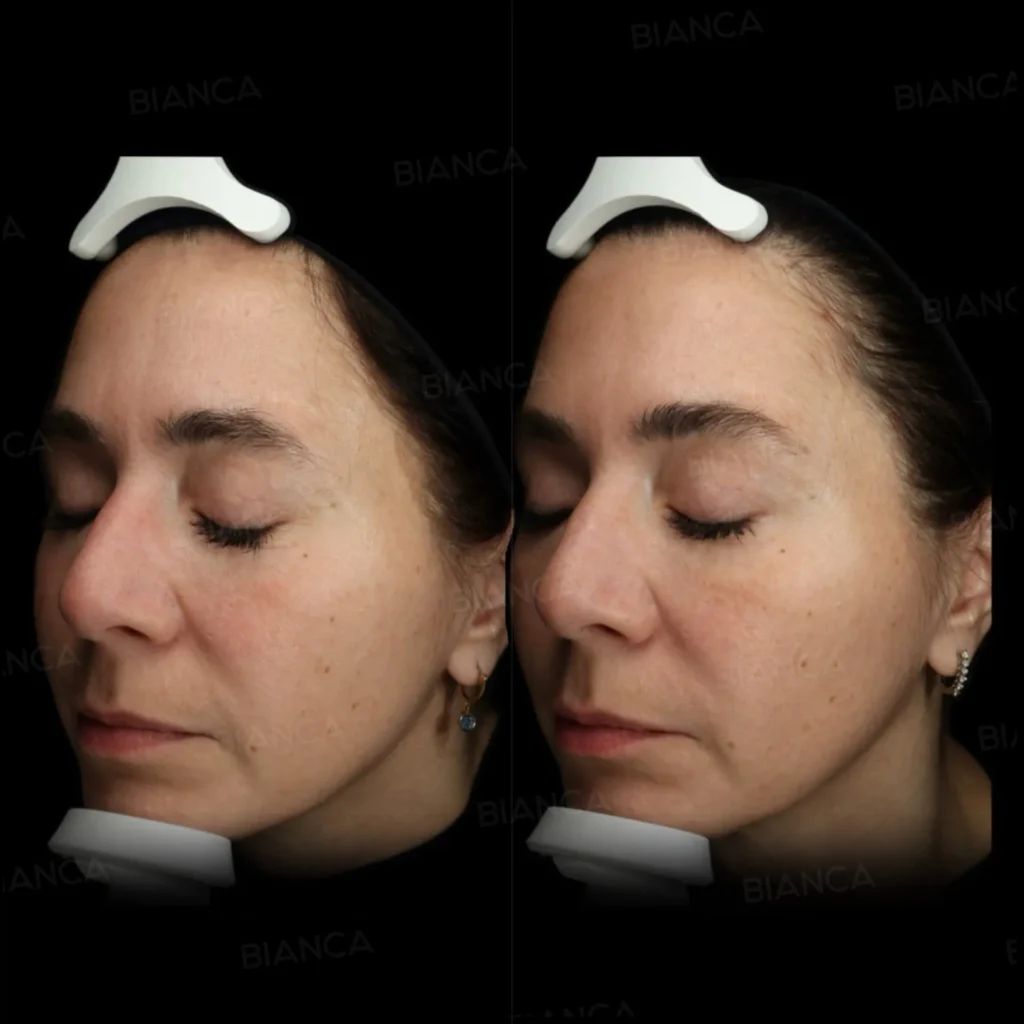Dermal Filler Injections Near Me: Finding English-Speaking and Friendly Medical Spa Services in Tokyo