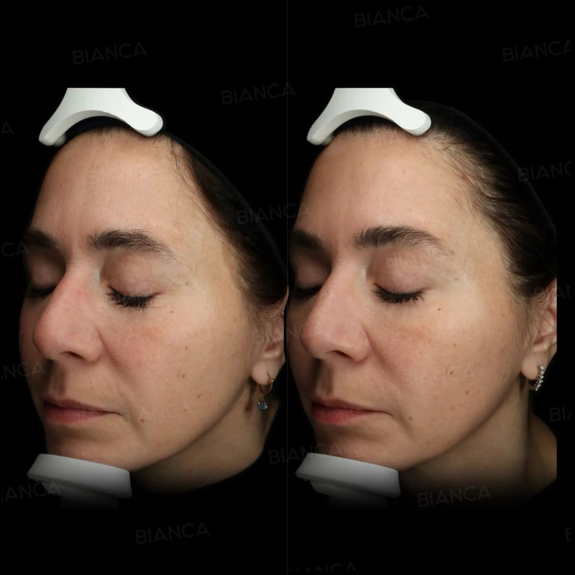 Dermal Filler Injections Near Me: Finding English-Speaking and Friendly Medical Spa Services in Tokyo