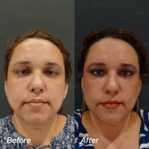 Before and after: Volnuma + HIFU ( Full face / Under chin )