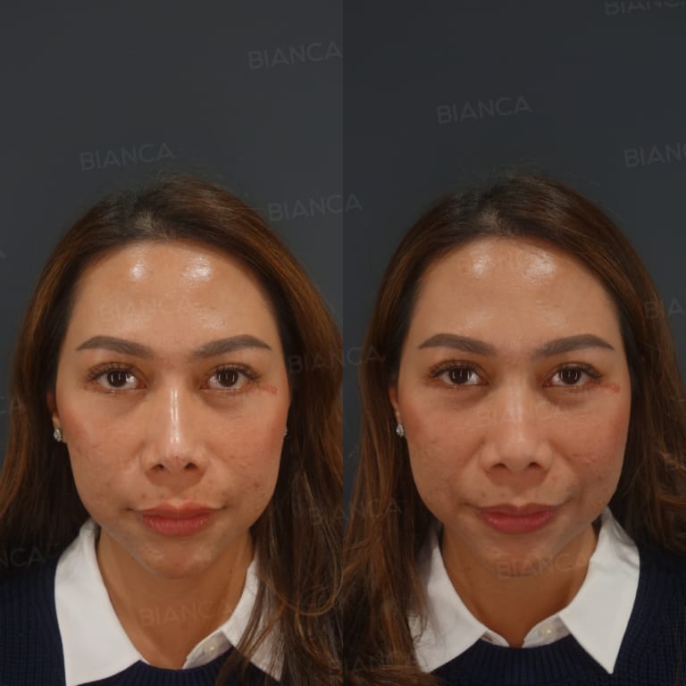 Before and after: Hyaluronic Acid Injection For Nose and Lips
