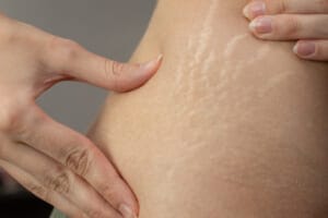 A young woman showing stretch marks on her skin.