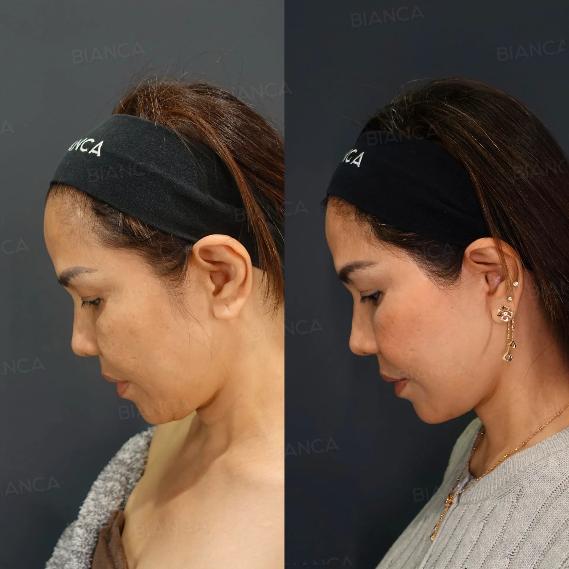 Plastic Surgery: Board-Certified Surgeon Expertise in Tokyo with BIANCA CLINIC