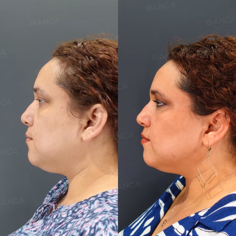 ThermaCool: RF Skin Tightening at a Trusted Medical Spa in Tokyo