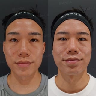 Glass Skin for Men: Top Aesthetic Treatments at a Medical Spa in Tokyo