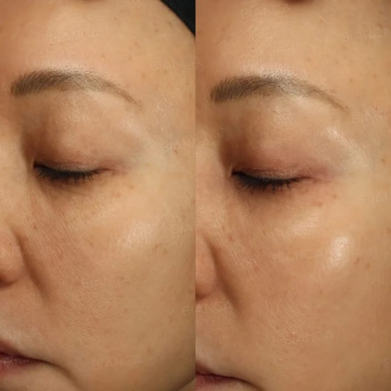 The Glass Skin Look in Tokyo: Gentle Treatments with Aesthetic Surgery Options at BIANCA CLINIC