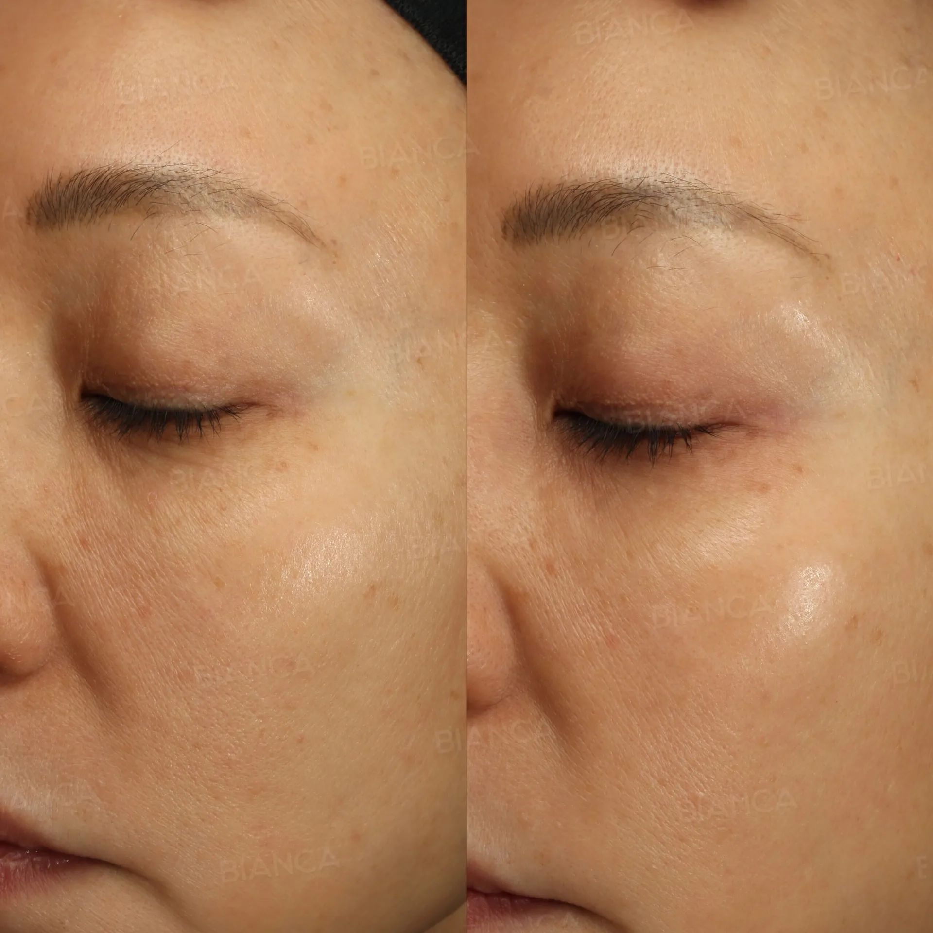 The Glass Skin Look in Tokyo: Gentle Treatments with Aesthetic Surgery Options at BIANCA CLINIC
