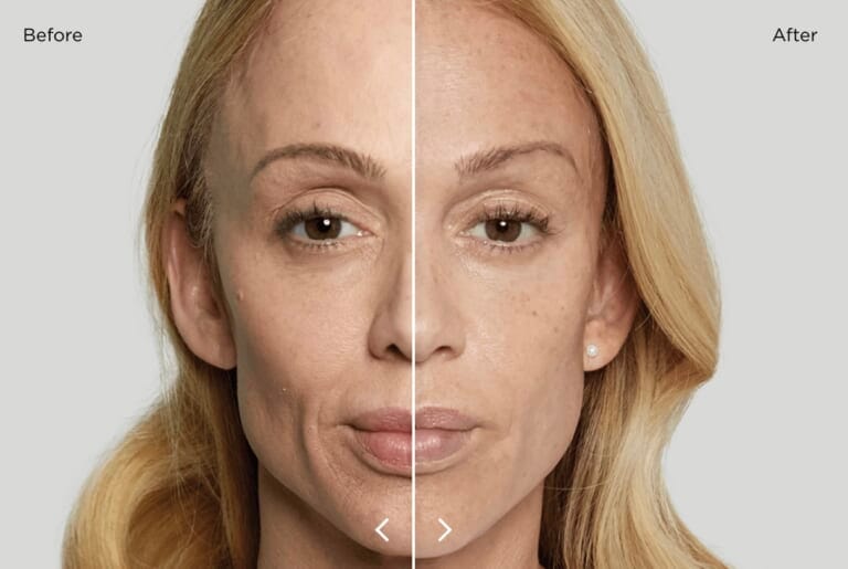 Sculptra Pros and Cons: Weighing Up Cosmetic Surgery and Aesthetic Treatment in Tokyo