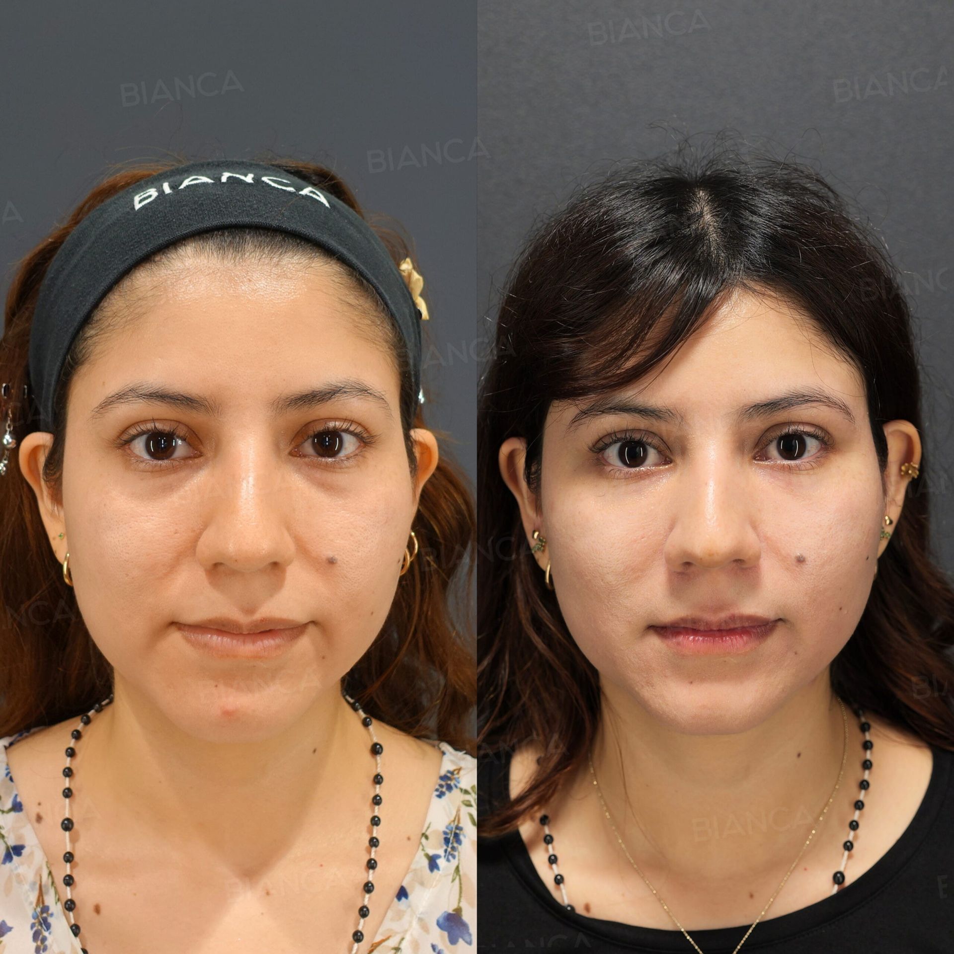 BabyCollagenInjection-UnderEye