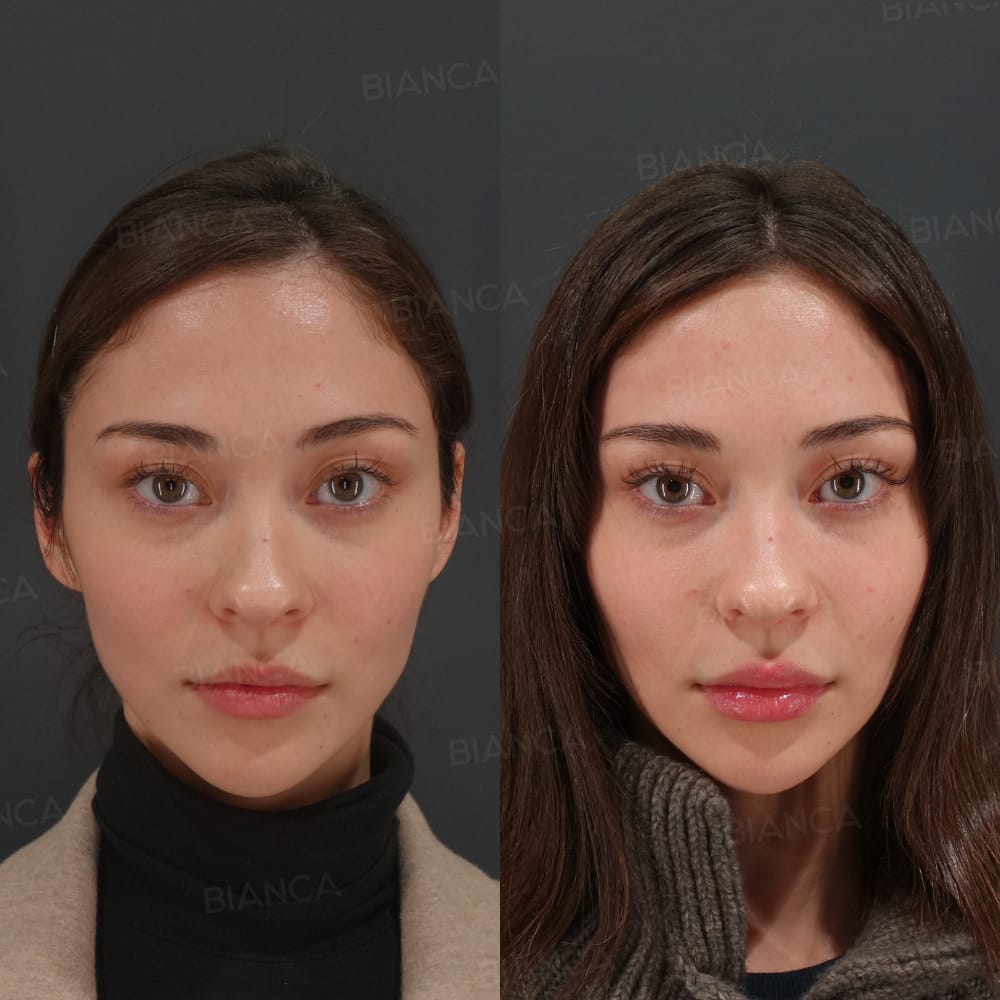Hyaluronic Acid Filler
