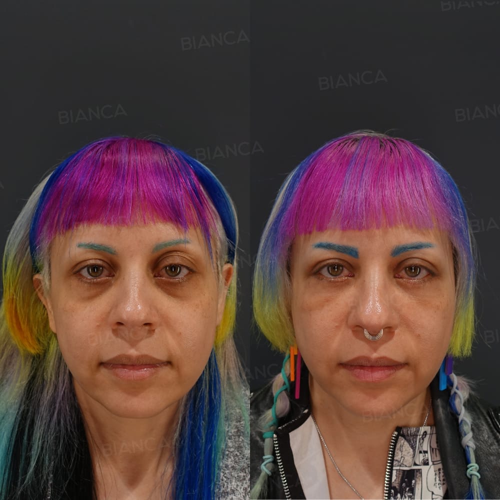 Midfacelift-Subperiosteal-Upper-Eyelid-Sagging-Removal