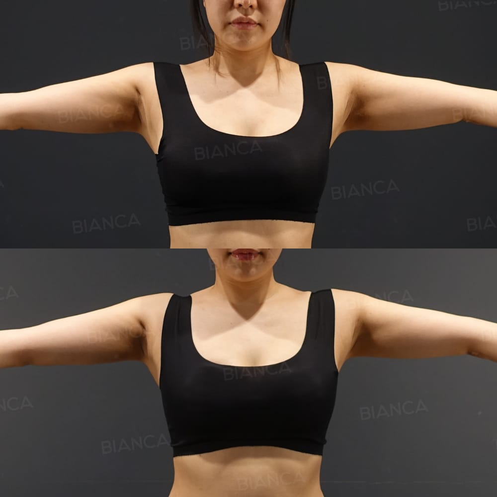 Vaser Liposuction on behind underarms and upper arms
