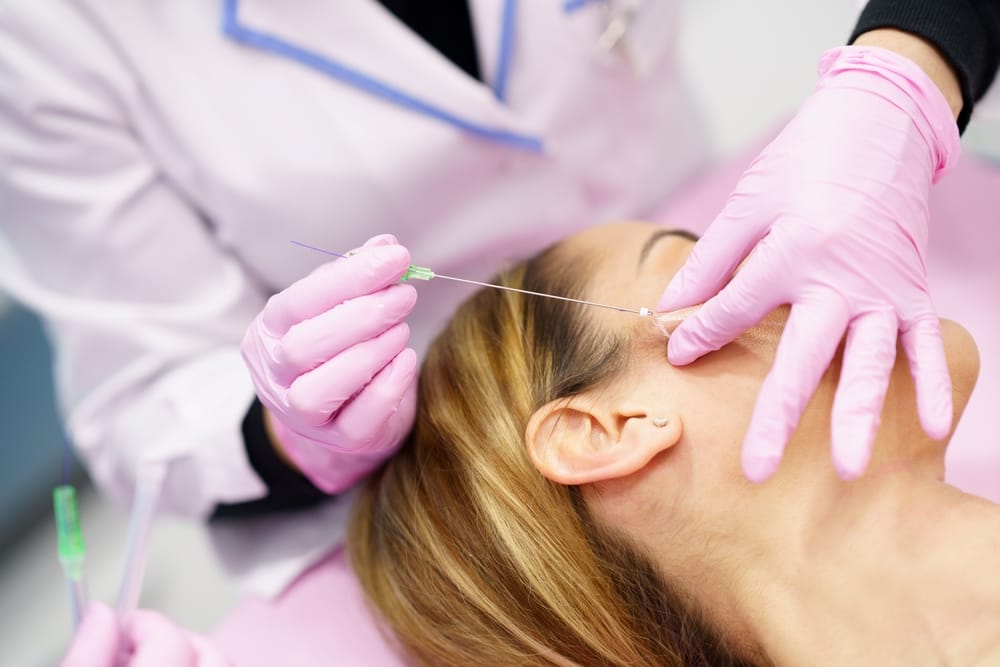 Clinician performing a thread lift procedure, treating a patient's temple and cheek area