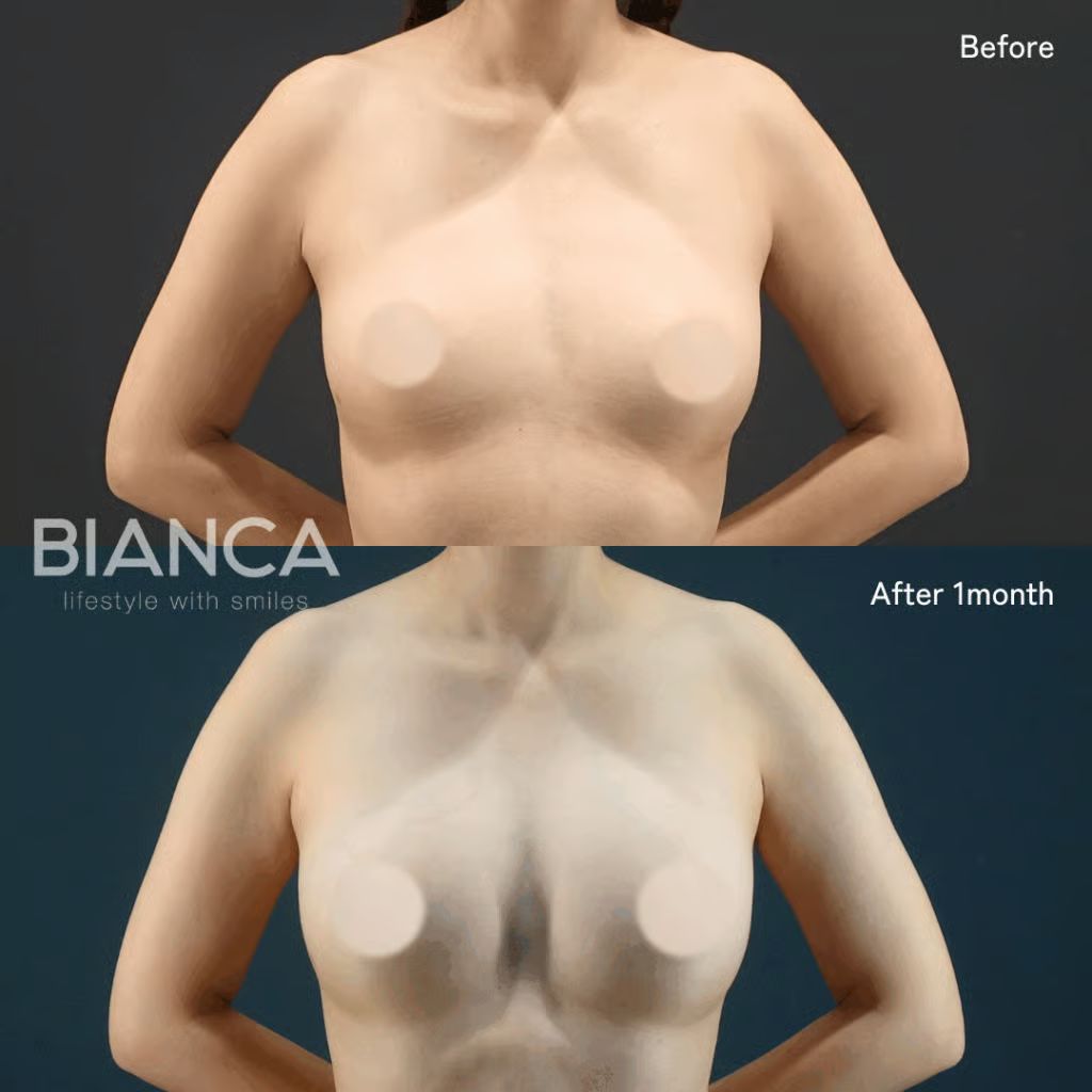 Before and 1 month after Condense Rich fat grafting breast augmentation.