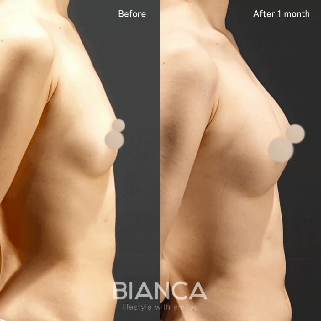 Left: Before treatment / Right: 1 month after Condense Rich fat grafting breast augmentation (side profile).
