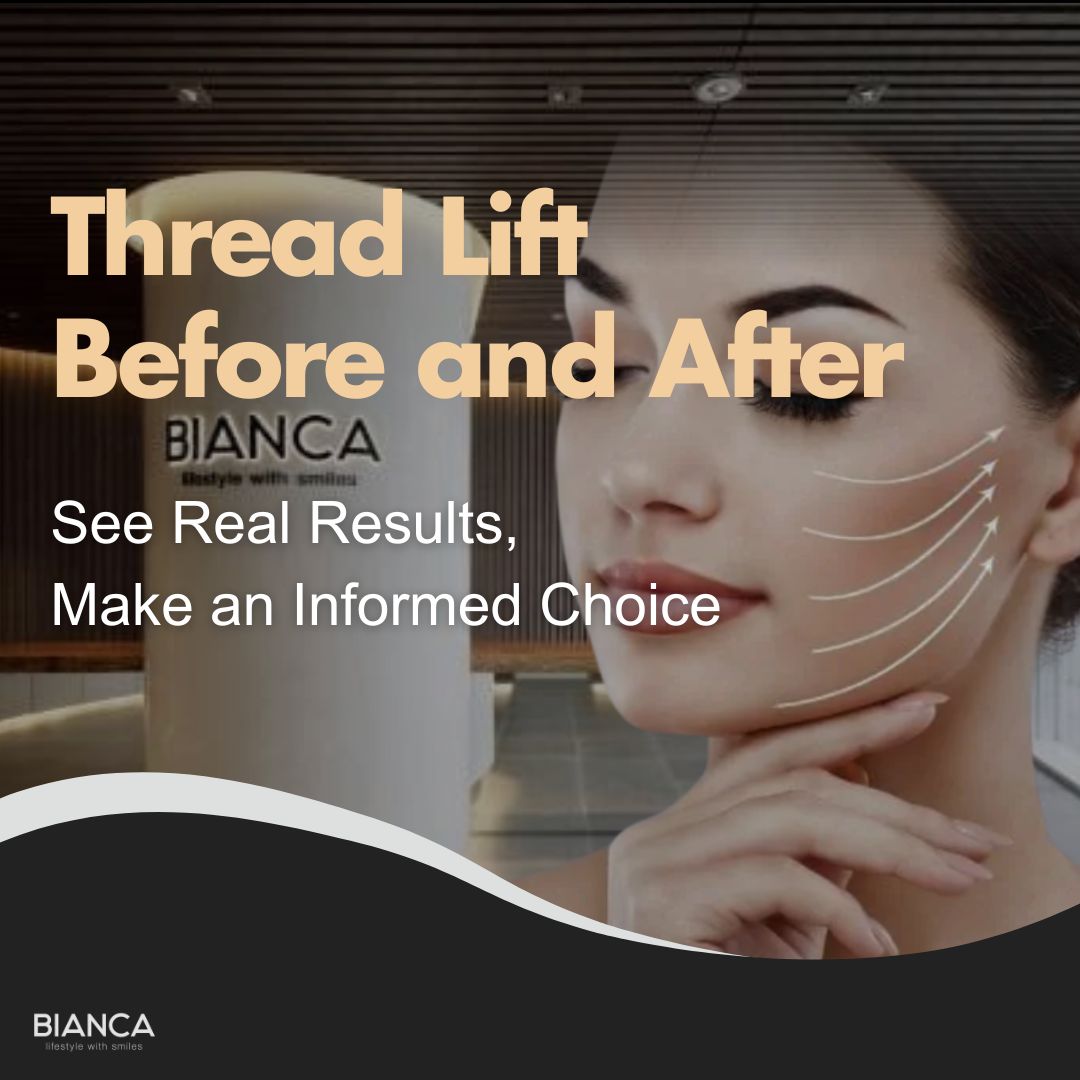 An eye-catching graphic by BIANCA CLINIC titled "Thread Lift Before and After." It features a woman's profile with white arrows illustrating the skin tightening and jawline lifting effects. Includes the text: "See Real Results, Make an Informed Choice