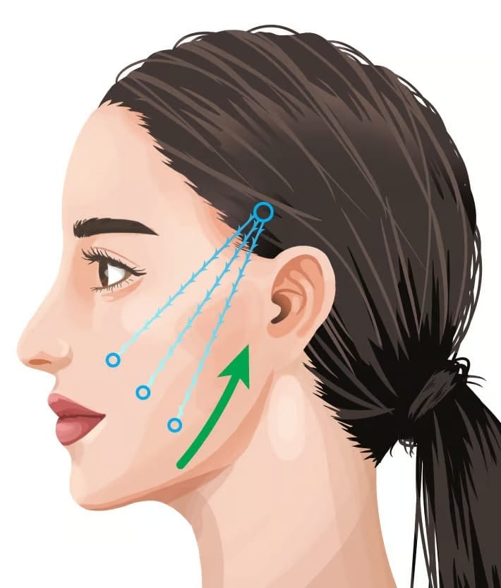 Illustration of a woman's face showing facelift treatment lines and lifting points