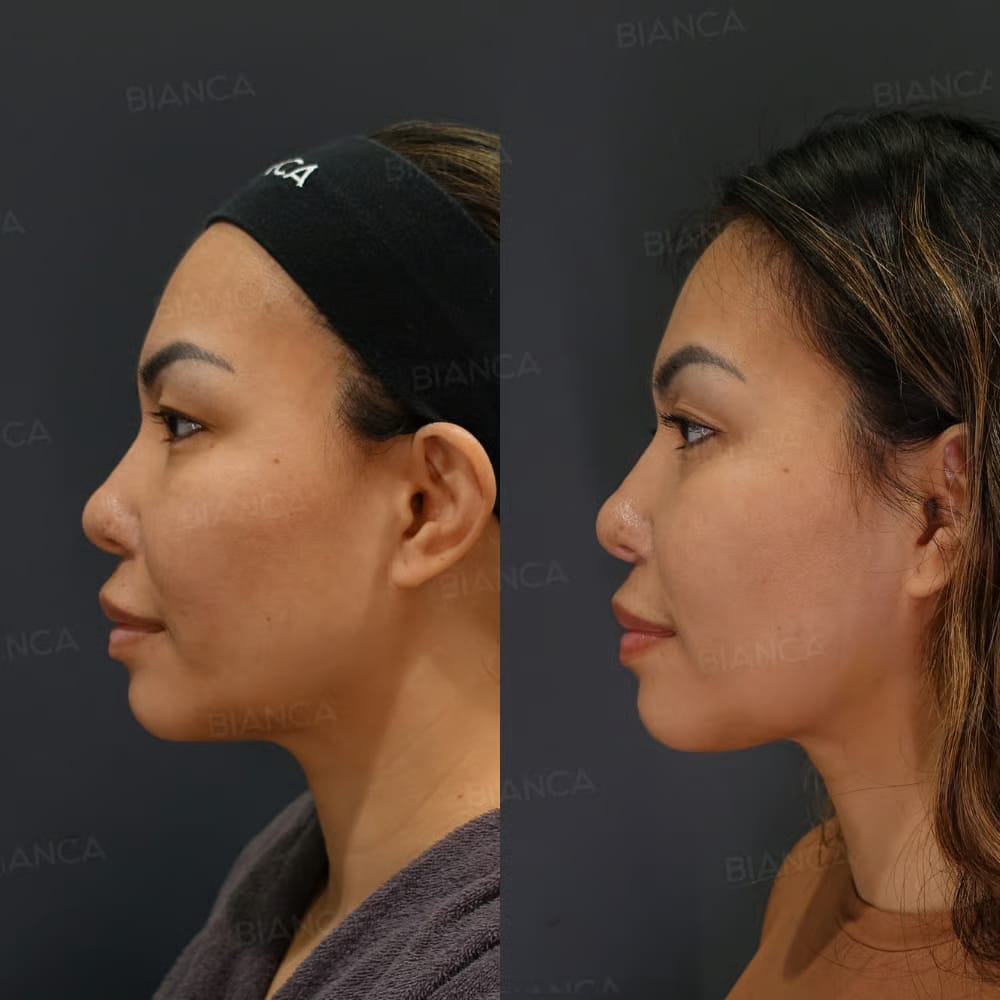 Before and after profile comparison of a woman's jawline following Morpheus8, liposuction, and BIANCA LIFT treatment